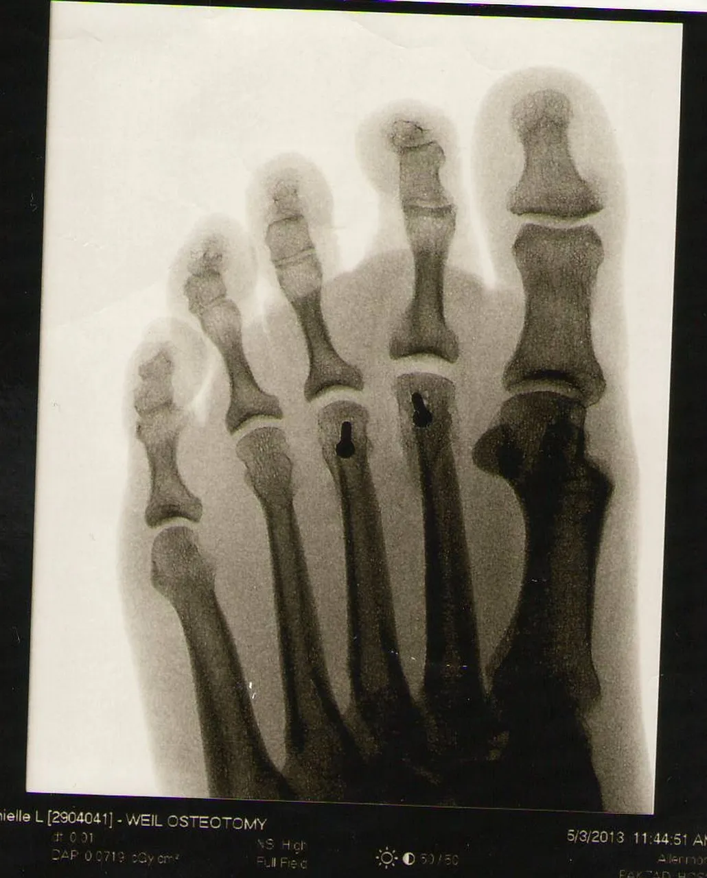 Who Invented X-Rays